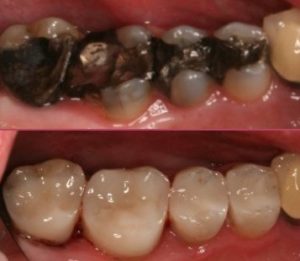 Root Fillings General Dentistry IOW