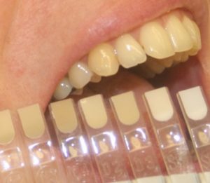White Fillings IOW Dentists Freshwater